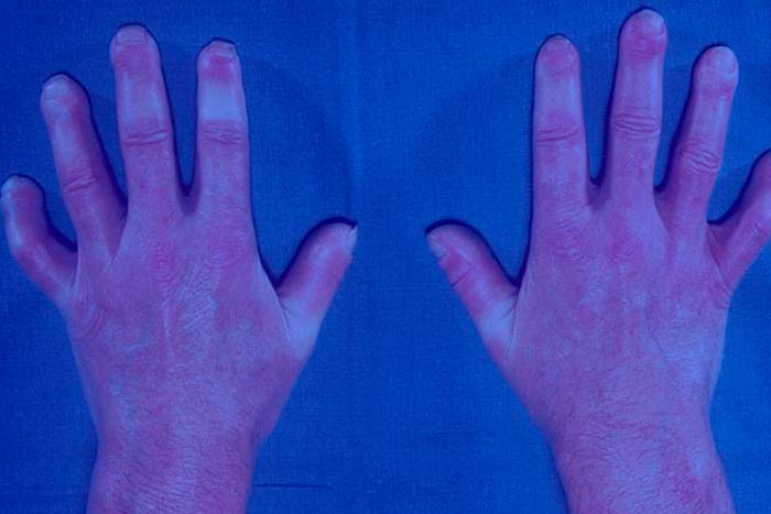 esclerodermia