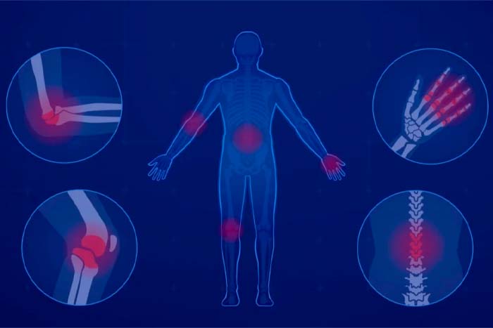 lupus-eritematoso-sistemico